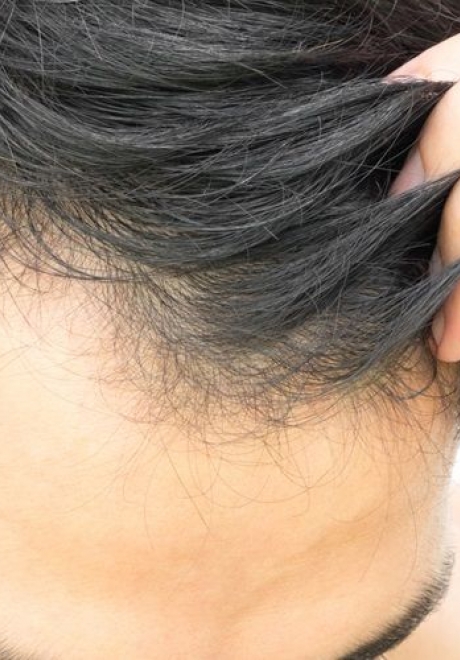 How Long Before My Wedding Should I Have My Hair Transplant?