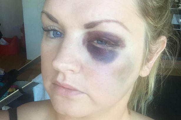 Groom Attacks and Breaks Bridesmaid's Face Groom Attacks and Breaks Bridesmaid's Face
